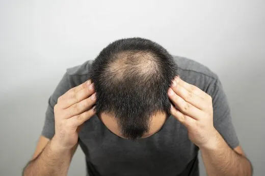 ۴ نکته خوراکی درباره ریزش موی سر