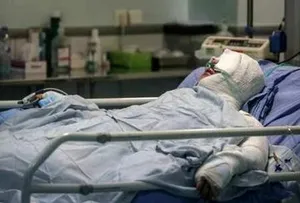 آمار وحشتناک از سوختگی/ هرسال چند نفر بر اثر سوختگی می‌میرند؟