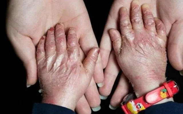 واکنش دادستان کل کشور به ماجرای پانسمان‌ های بیماران پروانه‌ ای