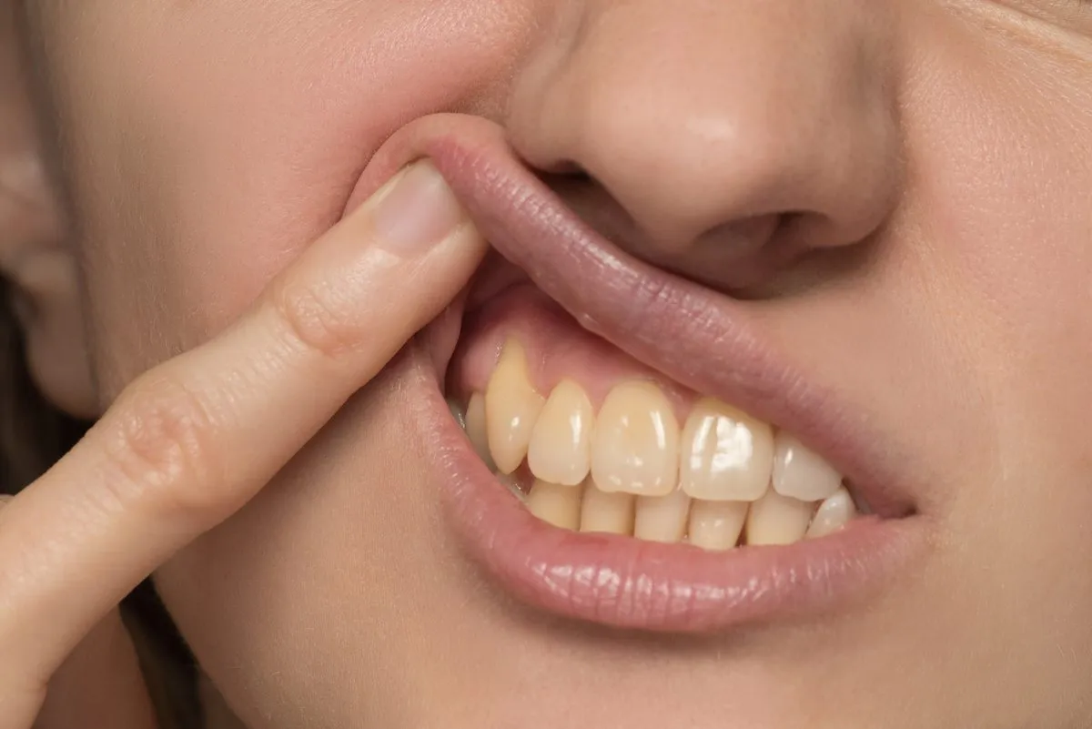 از لکه‌ های سیاه روی لثه چه می‌ دانید؟