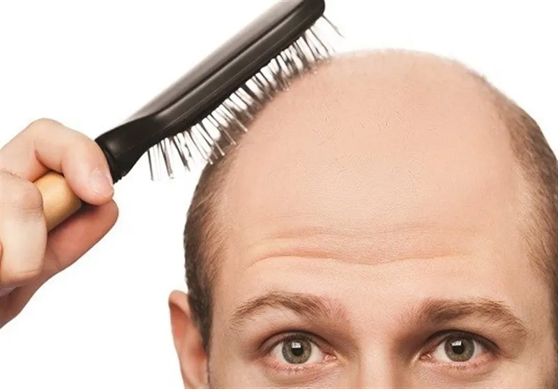چرا مردها طاس می‌شوند؟