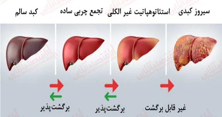 مراحل نارسایی کبد چیست؟