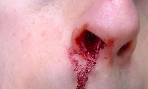 خون‌دماغ مکرر گاهی خطرناک است