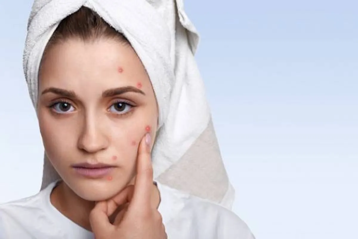 چی بخوریم، بیشتر جوش می زنیم؟
