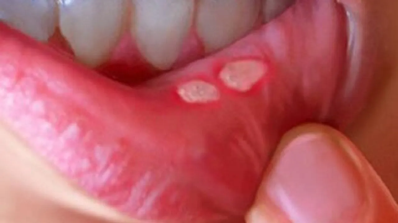 علت به وجود آمدن زخم دهان و زبان چیست؟