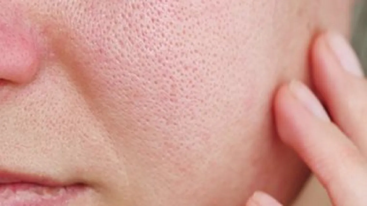 برطرف کردن قرمزی صورت با این روش