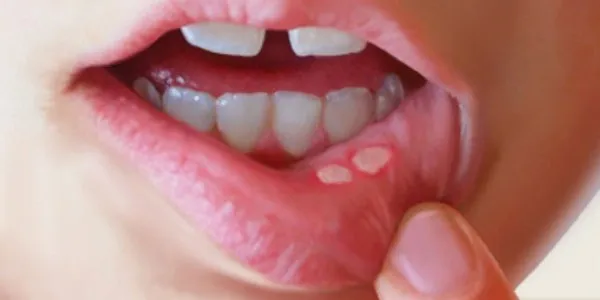 علل بروز آفت دهان چیست؟