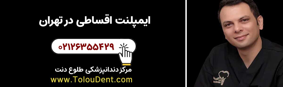 ایمپلنت اقساطی در تهران ایمپلنت اقساطی در تهران
