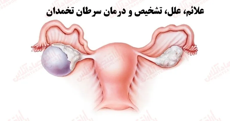 سرطان تخمدان، زمان‌ بندی، مراحل و علائم