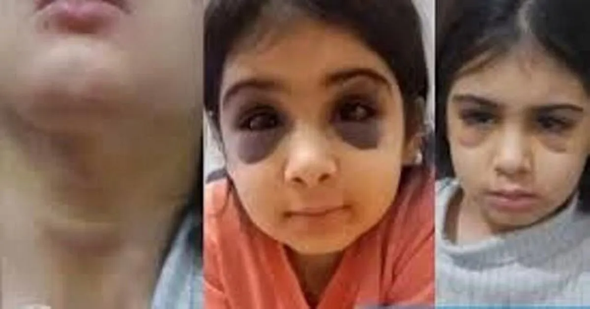 شکنجه و آزار وحشتناک دختربچه ۷ ساله سنندجی توسط نامادری/ چه بر سر آنیلا کوچولو آمده؟ + عکس و فیلم