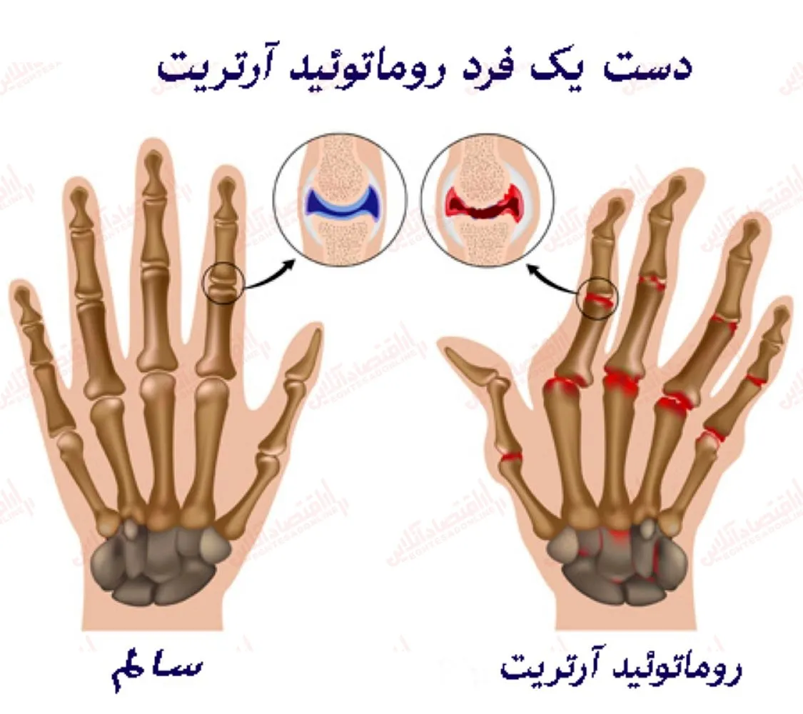 آرتریت روماتوئید در مقابل نقرس: چگونه تفاوت بین آن‌ ها را تشخیص دهیم؟