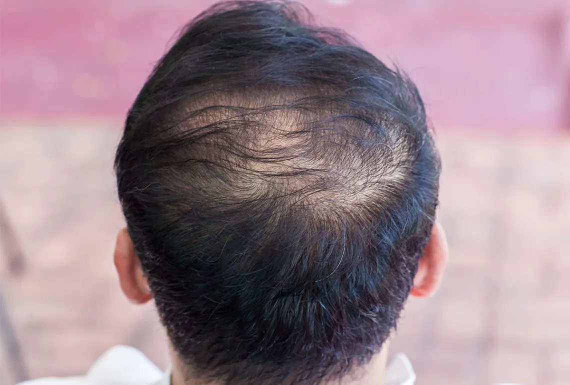 علت نازک شدن مو چیه؟