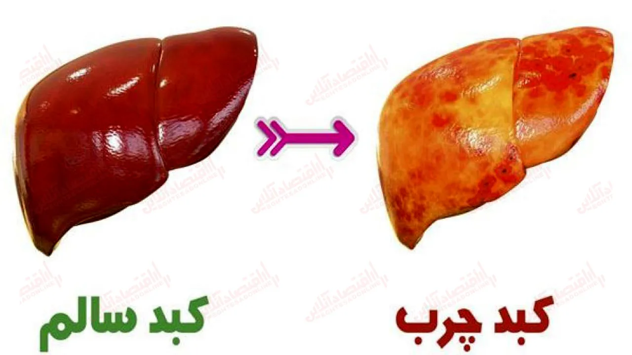 هرآنچه باید در مورد کبد چرب بدانید
