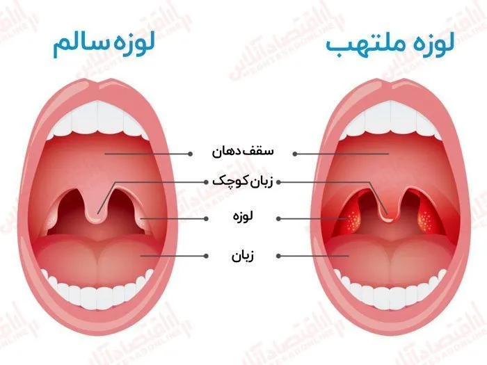 هر آنچه از التهاب لوزه باید بدانید