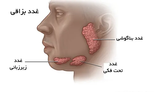 انواع بیماری‌های غدد بزاقی!