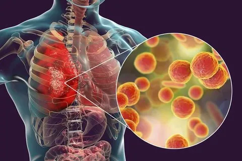 تاثیر فاکتورهای محیطی در بروز ذات الریه کودکان