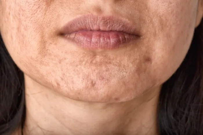 بررسی علل جوش چانه و نحوه درمان آن!