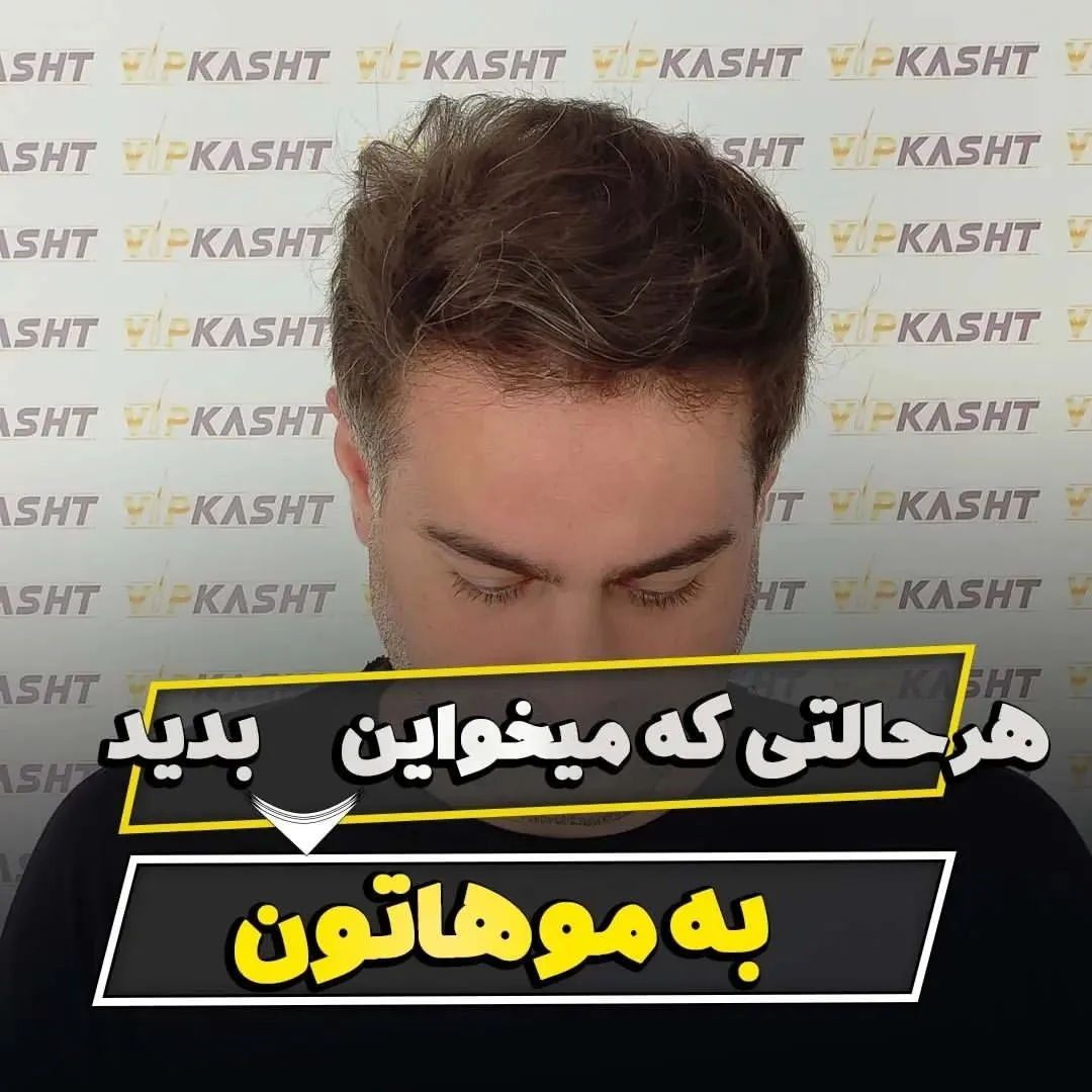 بهترین فوق تخصص کاشت مو در تهران- کلینیک vip