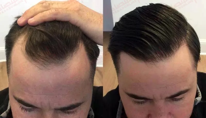 هرآنچه باید درباره کاشت مو از روش استخراج واحد فولیکولی دانست