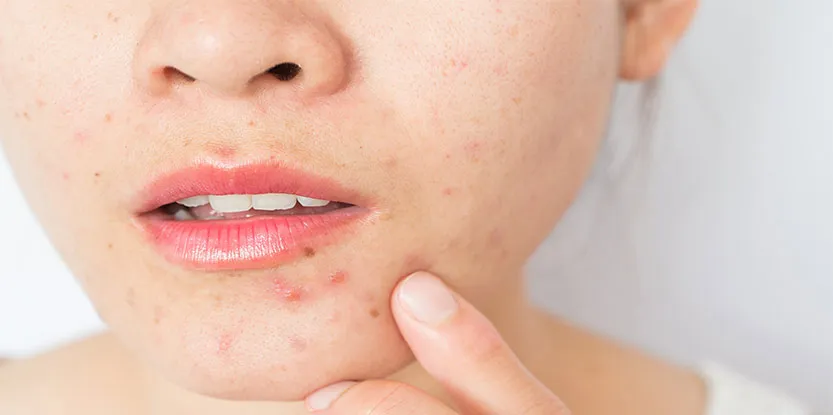 چگونه جوش چانه را از بین ببریم؟