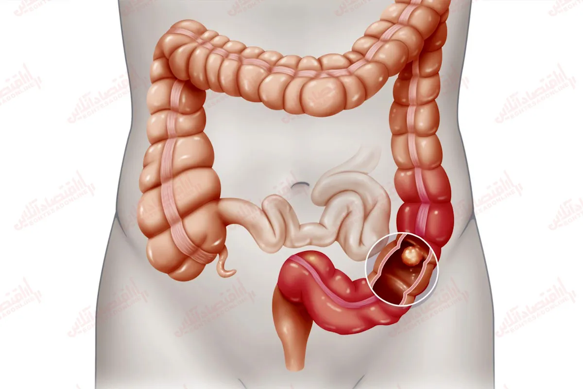 ایلئوس چیست؟