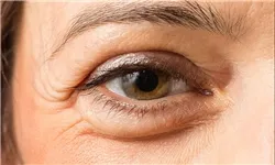 نکات طلایی برای برطرف کردن پف زیر چشم‌ها