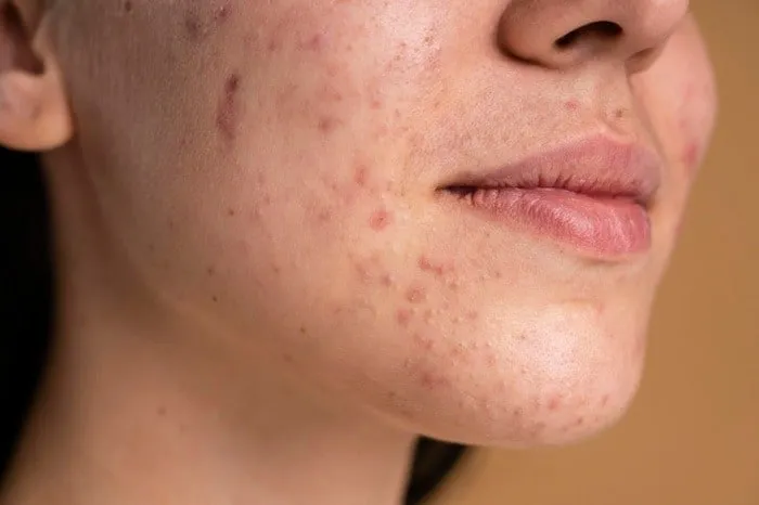 چگونه صورتی بدون جوش و لک داشته باشیم؟