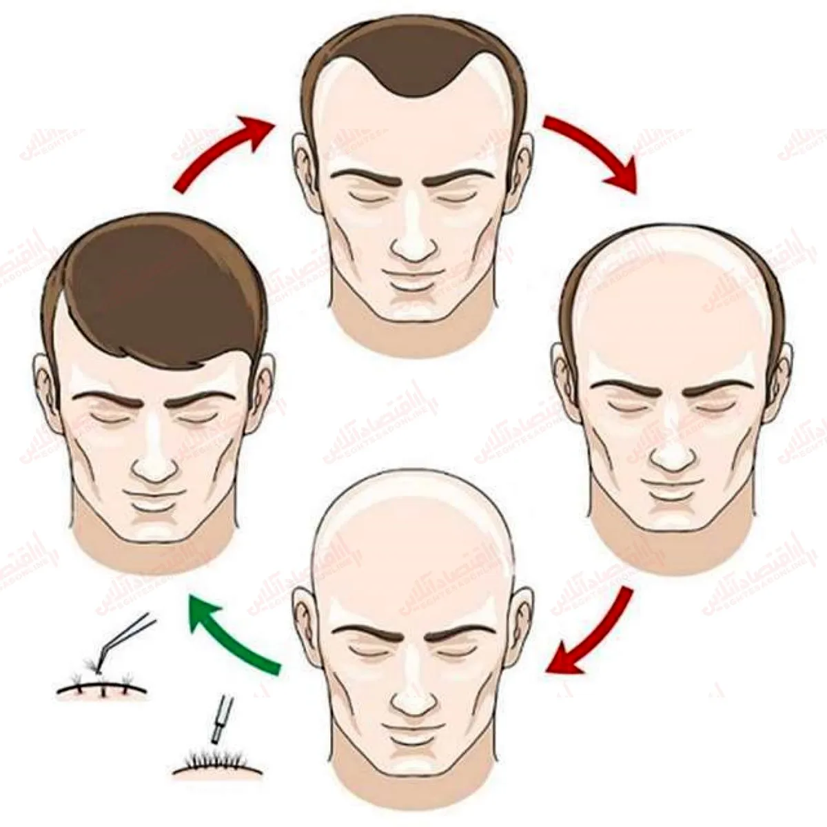 هرآنچه در مورد کاشت مو باید دانست