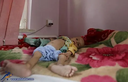 گرسنگی کودکان یمن +عکس