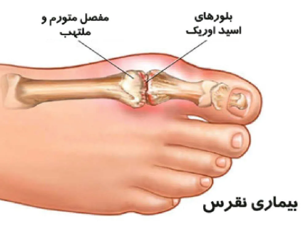 راه های کاهش  اسید اوریک  بالا