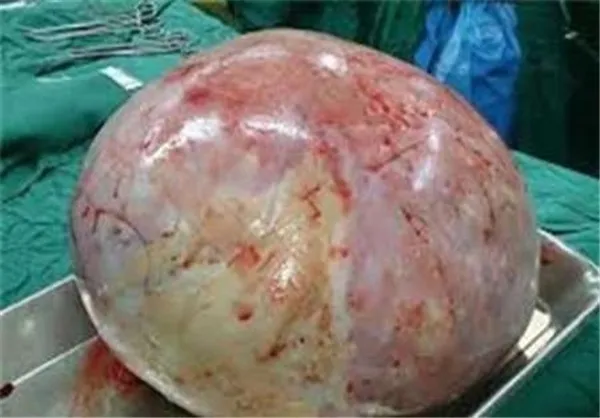 توده چهار و نیم کیلویی از شکم بانوی ۱۸ساله خارج شد +تصویر