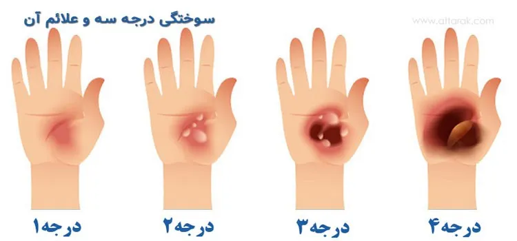 انواع درجات سوختگی پوست را بشناسید + فیلم