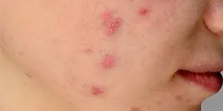 تاثیر مخرب استرس مزمن بر سلامت پوست