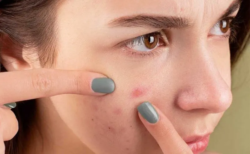 قرصی که برای پوست معجزه می کند + عوارض راکوتان
