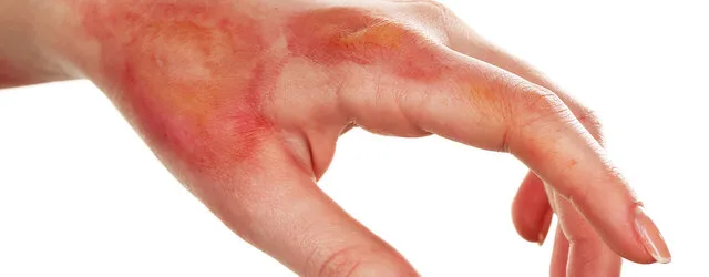 چگونه سوختگی را درمان کنیم؟
