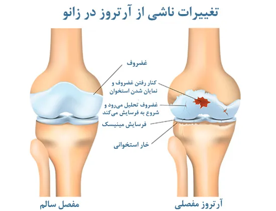 آرتروز زودرس در کمین ورزشکاران حرفه‌ای