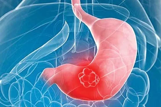 تغذیه برای درمان علائم گاستریت