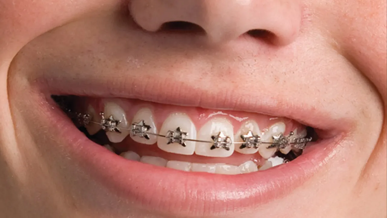 ارتودنسی دندان برای کدام افراد ضروری است؟